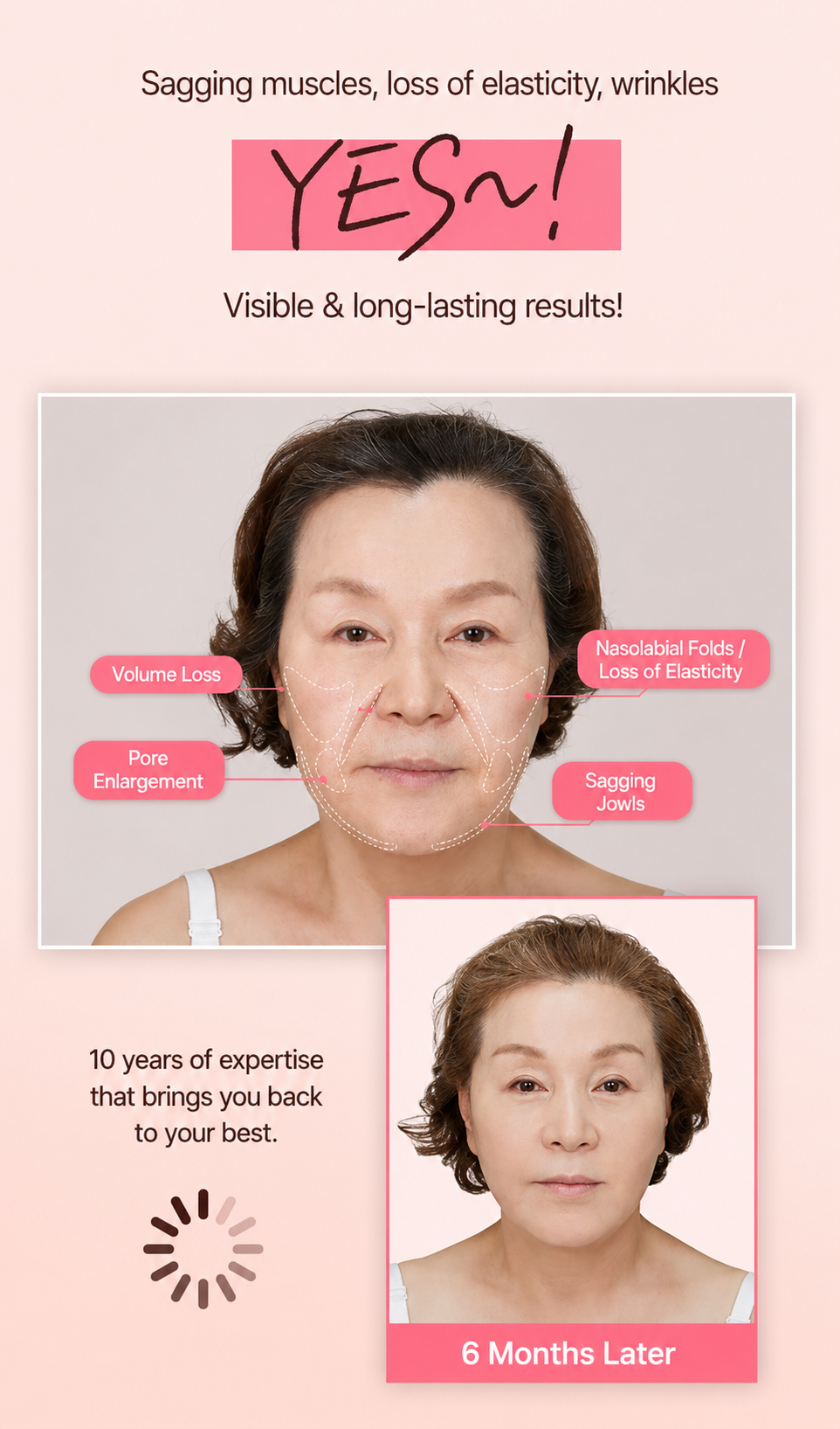 Facial aging concerns and a patient result six months after face lifting