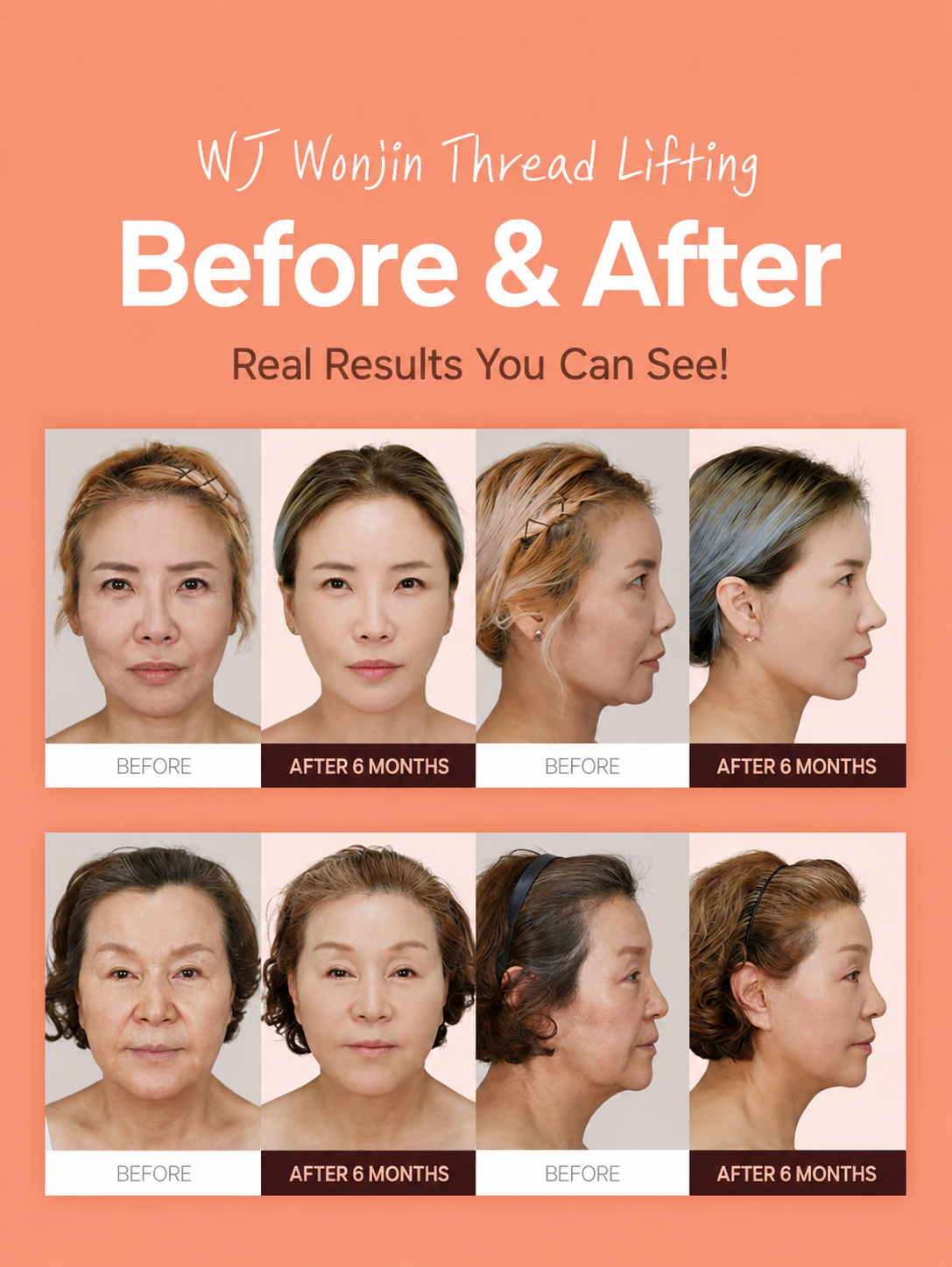 Face lifting patients before and six months after