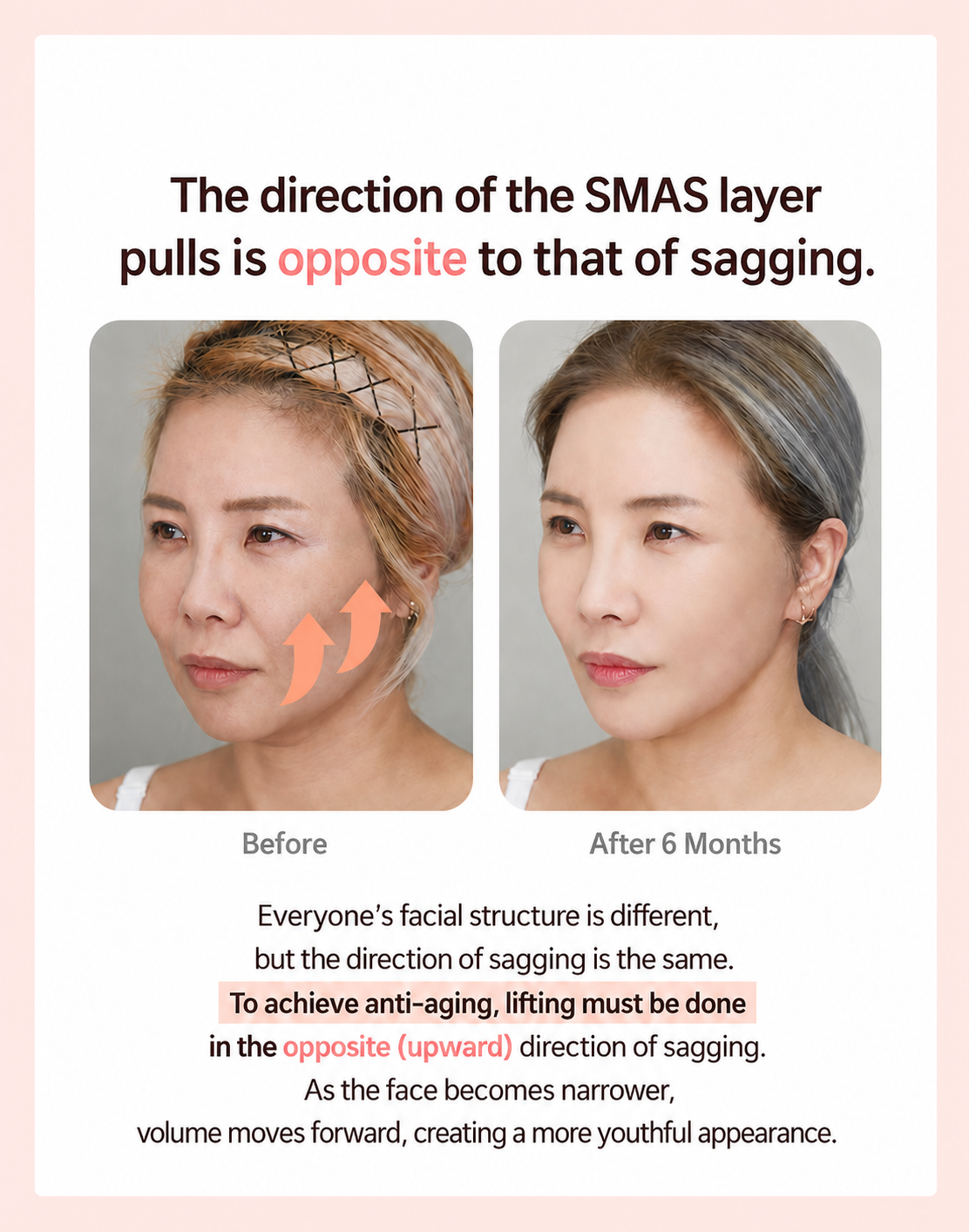 SMAS lifting direction before and after