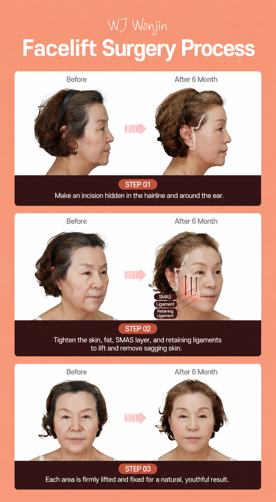 WJ Wonjin facelift surgery process in three steps