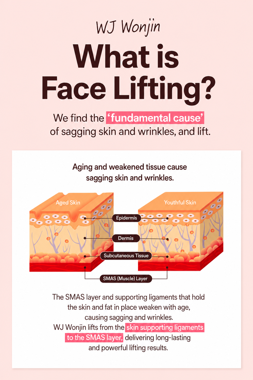 Explanation of facial lifting and the SMAS layer