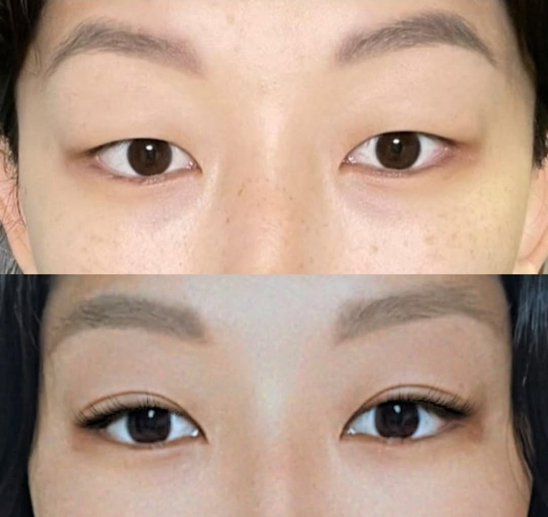 Double eyelid and eye shape correction before and after