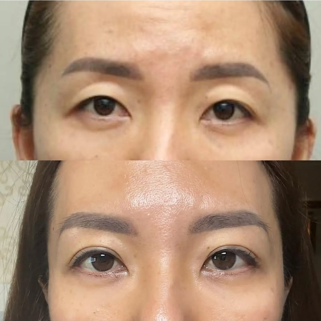 Double eyelid surgery and under-eye fat repositioning before and after