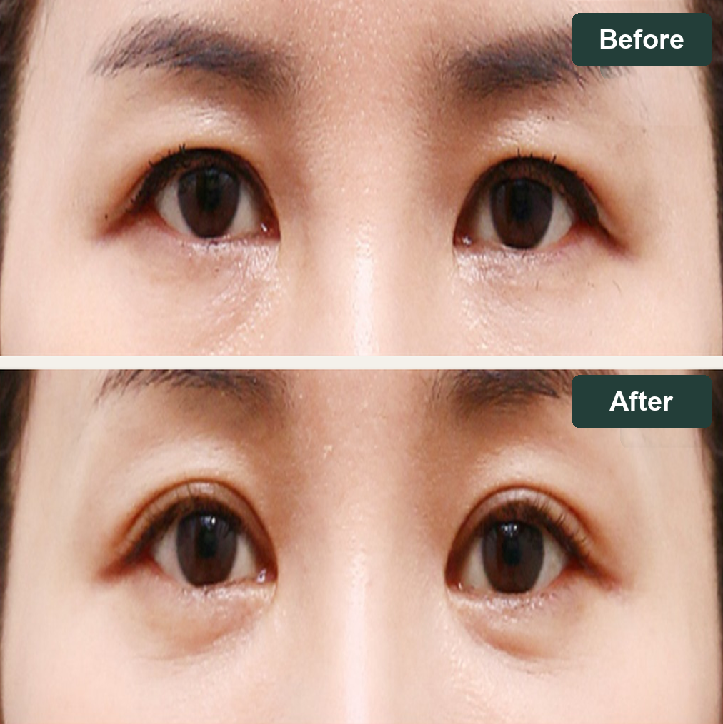 Forehead lift before and after