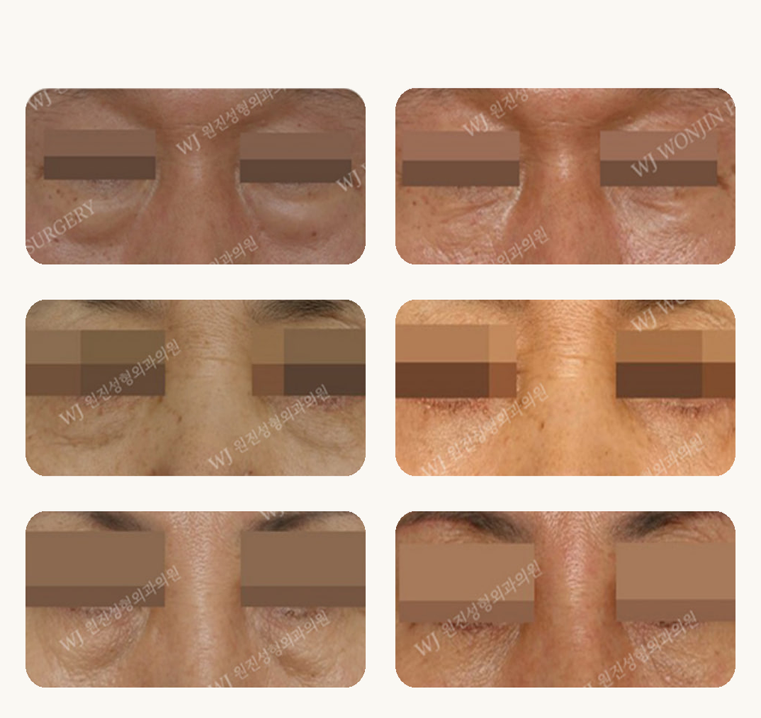 Lower eyelid surgery before and after cases