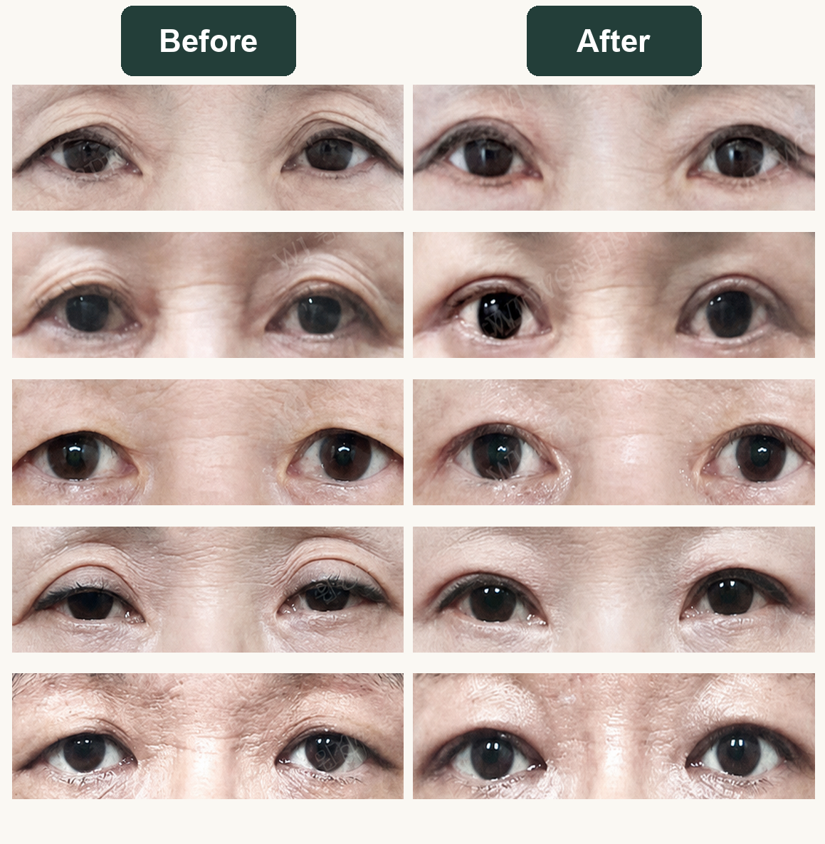 Upper blepharoplasty before and after patient cases